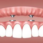 Are Dental Implant Procedures Safe?