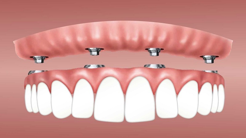Are Dental Implant Procedures Safe?